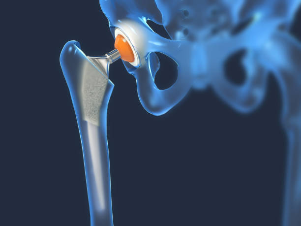 Best Hip Replacement Surgeon in Thane